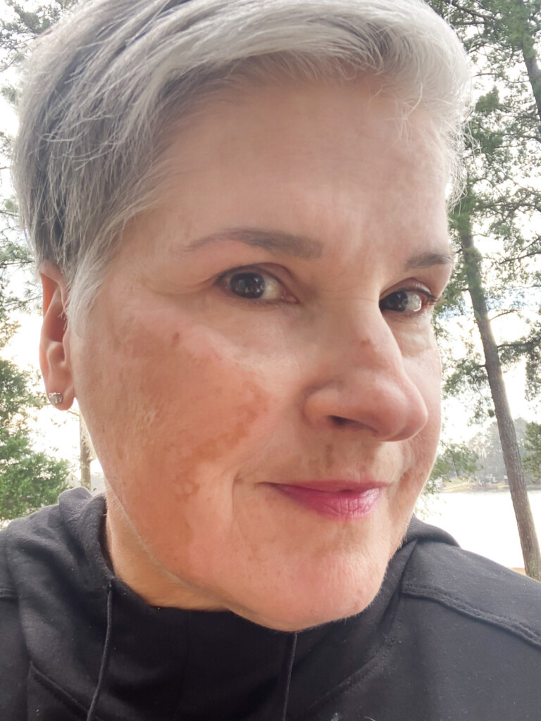 Vitiligo on face